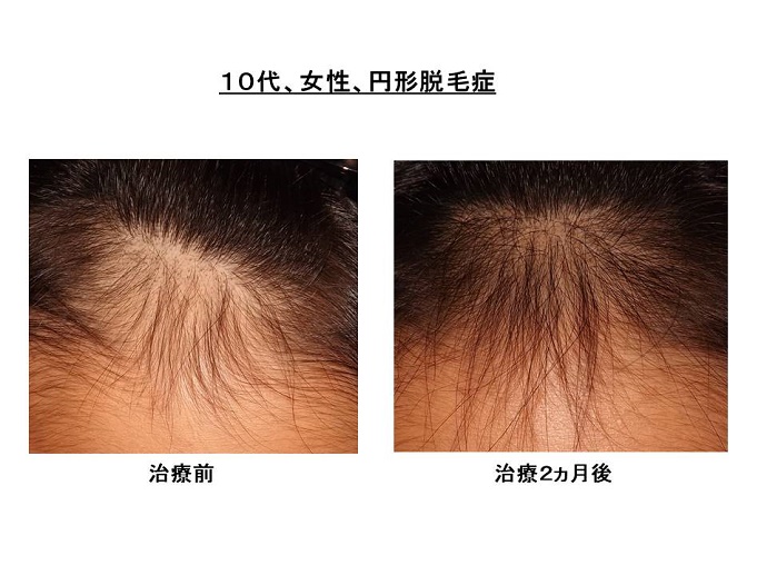 円形脱毛症　病院""